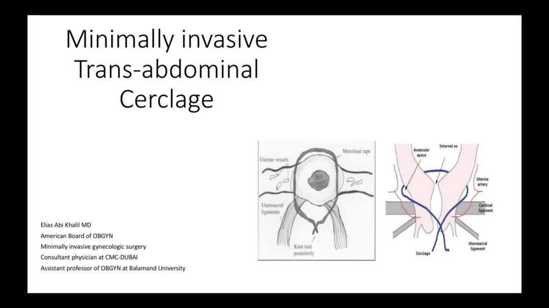 ⁣Robotic assisted cerclages for prevention of preterm birth | Elias abi khalil